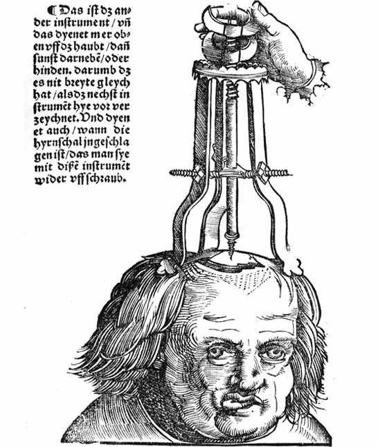 Dessin d'une trépanation (1517). Wikipedia.